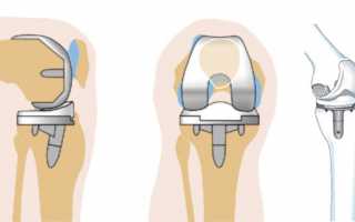 Операция по замене коленного сустава