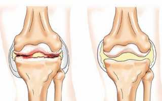 Причины и лечение гонартроза
