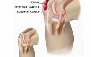 Супрапателлярный бурсит сустава колена
