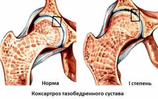 Коксартроз тазобедренного сустава первой степени