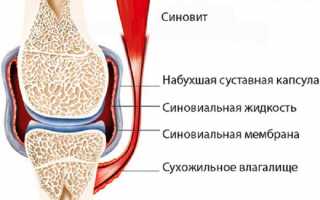 Причины и лечение синовита