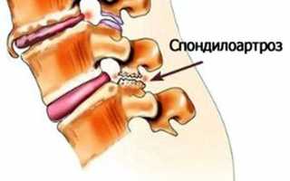 Поясничный спондилоартроз