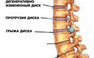 Межпозвоночная грыжа и бег