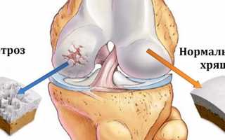 Причины и лечение артроза