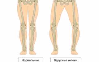 Варусное искривление нижних конечностей