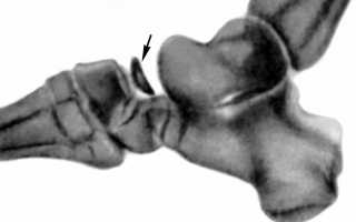 Остеохондропатия ладьевидной кости ступни