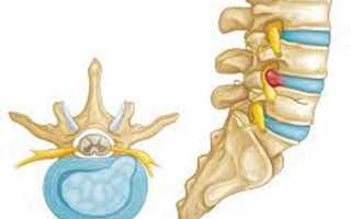 Грыжа межпозвонкового диска L4-L5