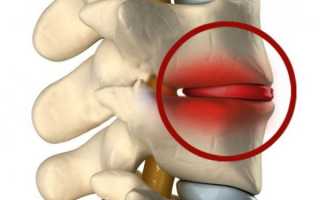 Спондилодисцит позвоночника