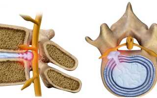Протрузия диска Л5-С1