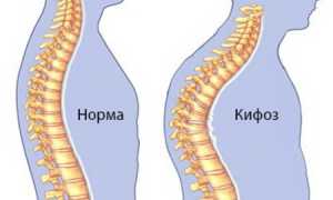 Лордоз и кифоз позвоночного столба