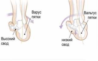 Варусная стопа у взрослых и детей