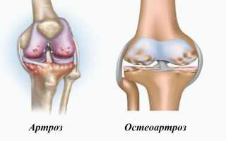 Остеоартроз или артроз?