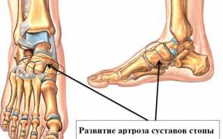 Артроз ступни