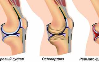 Отличие остеоартроза от артрита