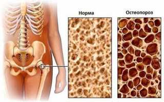 Остеопороз в старческом возрасте