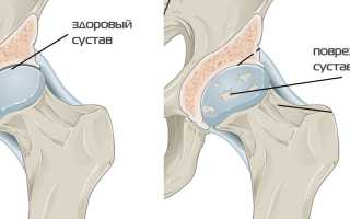 Киста в тазобедренном суставе