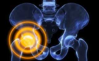 Причины и лечение транзиторного синовита