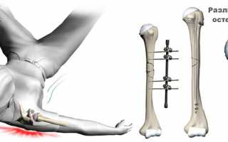 Остеосинтез кости плеча