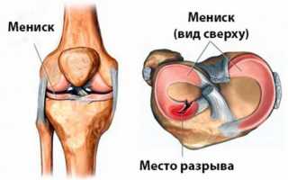 Разрыв коленного мениска