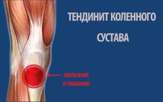 Тендинит колена
