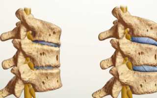 Остеоартроз спины