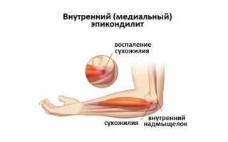 Диагностика и лечение медиального эпикондилита