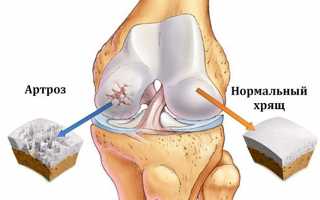 Артроз коленного сустава первой степени