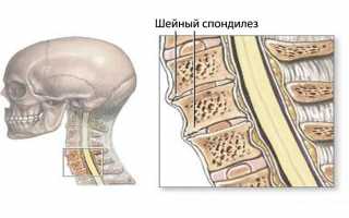 Шейный спондилез
