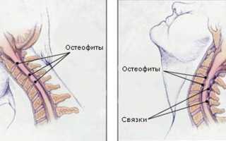 Остеофиты в шейном отделе позвоночника