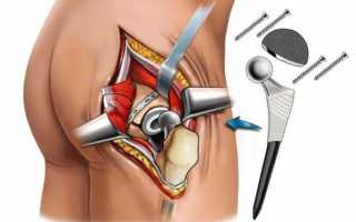 Альтернатива замене тазобедренного сустава