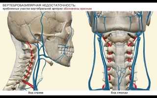 Вертебро-базилярная недостаточность на фоне шейного остеохондроза