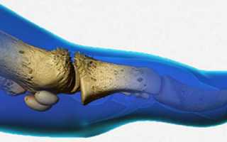 Остеоартроз плюснефаланговых суставов
