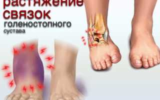 Сколько времени заживает растяжение связок голеностопа?