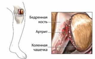 Хондрокальциноз колена