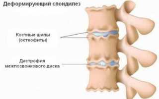 Причины и лечение деформирующего спондилеза