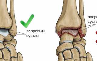 Симптомы и лечение деформирующего остеоартроза