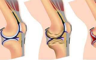 Деформирующий артроз сустава колена