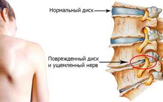 Пластырь при остеохондрозе