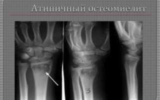 Атипичная форма остеомиелита