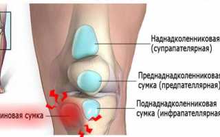 Анзериновый бурсит сустава колена