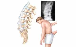 Пояснично-крестцовый спондилез