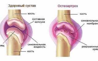 Причины и лечение остеоартроза суставов