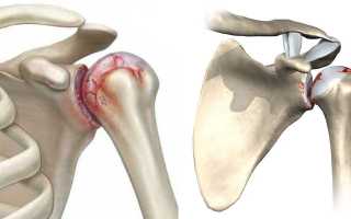 Остеоартроз сустава плеча