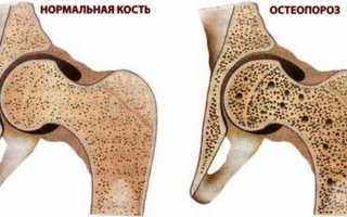 Как укрепить кости при остеопорозе?