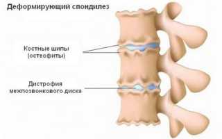 Деформирующий поясничный спондилез