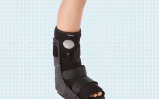 Что лучше использовать гипс или ортез?