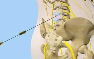 Блокада при межпозвоночной грыже