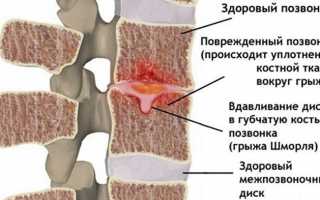 Грыжа Шморля в пояснице