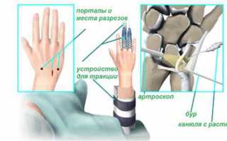 Артроскопия кисти