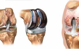 Коленный эндопротез Depuy